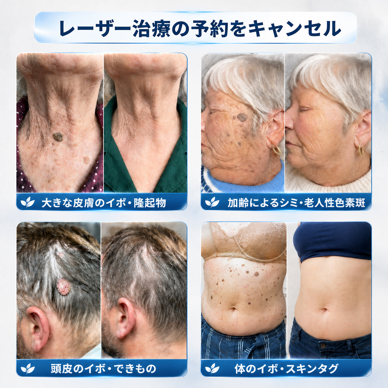 👑薬剤師もおすすめ💕 Hiskin® 7日間 タグ＆スポットイレーサー🪄 （痛みゼロ・傷あとゼロを目指すローラーボールタイプ）👩‍⚕️