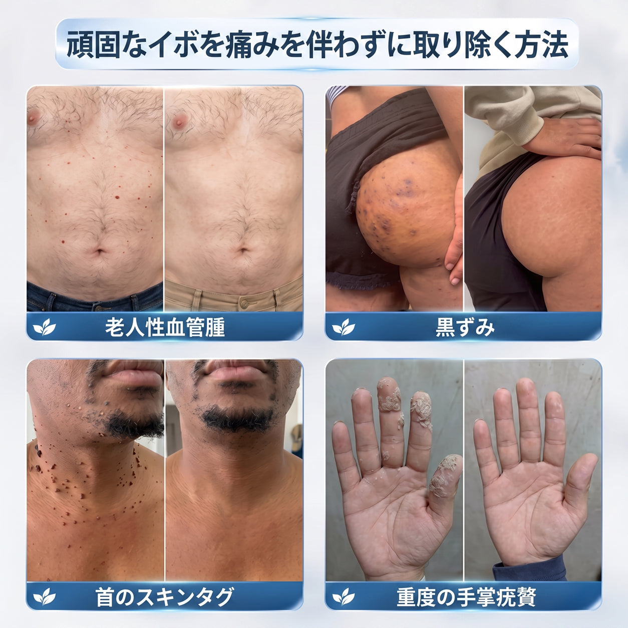 👑薬剤師もおすすめ💕 Hiskin® 7日間 タグ＆スポットイレーサー🪄 （痛みゼロ・傷あとゼロを目指すローラーボールタイプ）👩‍⚕️