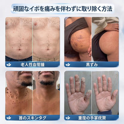 👑薬剤師もおすすめ💕 Hiskin® 7日間 タグ＆スポットイレーサー🪄 （痛みゼロ・傷あとゼロを目指すローラーボールタイプ）👩‍⚕️