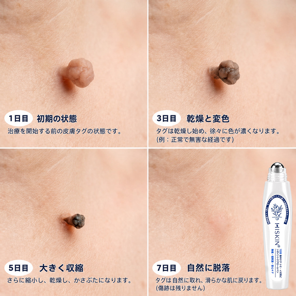 👑薬剤師もおすすめ💕 Hiskin® 7日間 タグ＆スポットイレーサー🪄 （痛みゼロ・傷あとゼロを目指すローラーボールタイプ）👩‍⚕️