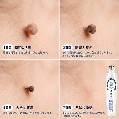 👑薬剤師もおすすめ💕 Hiskin® 7日間 タグ＆スポットイレーサー🪄 （痛みゼロ・傷あとゼロを目指すローラーボールタイプ）👩‍⚕️
